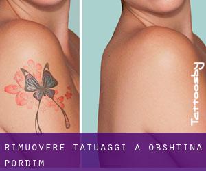Rimuovere Tatuaggi a Obshtina Pordim