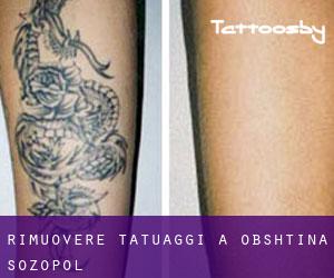 Rimuovere Tatuaggi a Obshtina Sozopol