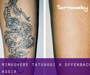 Rimuovere Tatuaggi a Offenbach (Assia)