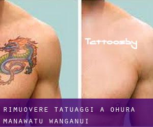 Rimuovere Tatuaggi a Ohura (Manawatu-Wanganui)