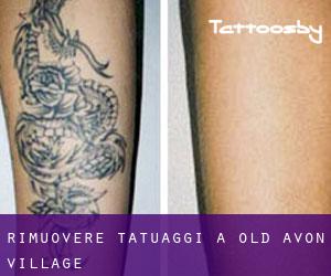 Rimuovere Tatuaggi a Old Avon Village