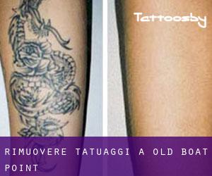 Rimuovere Tatuaggi a Old Boat Point