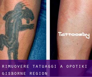 Rimuovere Tatuaggi a Opotiki (Gisborne Region)