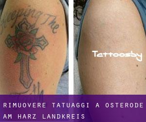Rimuovere Tatuaggi a Osterode am Harz Landkreis