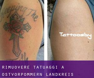 Rimuovere Tatuaggi a Ostvorpommern Landkreis