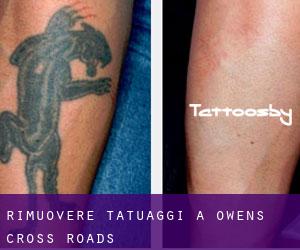 Rimuovere Tatuaggi a Owens Cross Roads