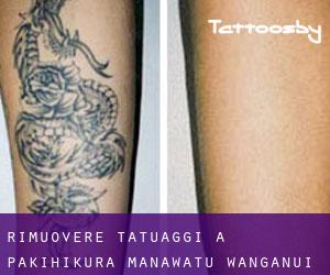 Rimuovere Tatuaggi a Pakihikura (Manawatu-Wanganui)