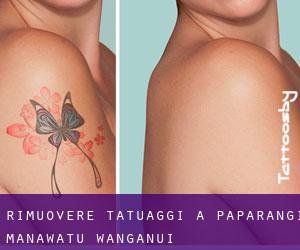 Rimuovere Tatuaggi a Paparangi (Manawatu-Wanganui)