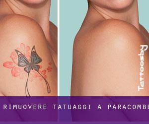 Rimuovere Tatuaggi a Paracombe