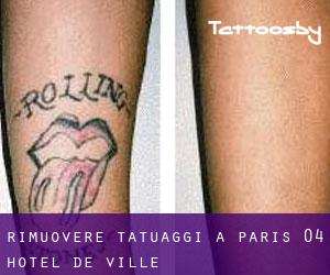 Rimuovere Tatuaggi a Paris 04 Hôtel-de-Ville