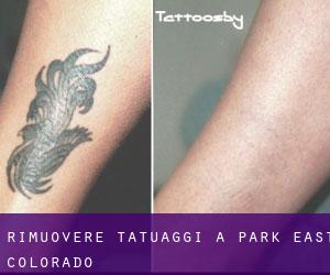 Rimuovere Tatuaggi a Park East (Colorado)
