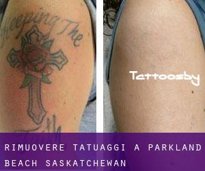 Rimuovere Tatuaggi a Parkland Beach (Saskatchewan)