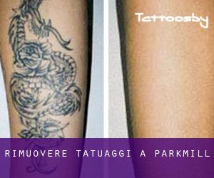 Rimuovere Tatuaggi a Parkmill