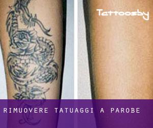 Rimuovere Tatuaggi a Parobé