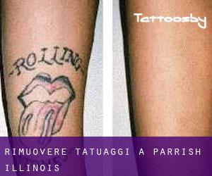 Rimuovere Tatuaggi a Parrish (Illinois)