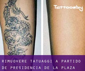 Rimuovere Tatuaggi a Partido de Presidencia de la Plaza