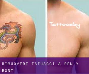 Rimuovere Tatuaggi a Pen-y-bont
