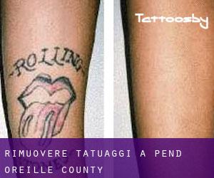 Rimuovere Tatuaggi a Pend Oreille County