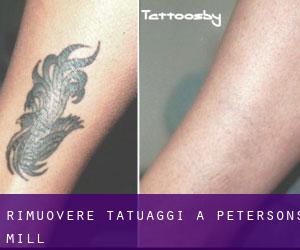 Rimuovere Tatuaggi a Petersons Mill