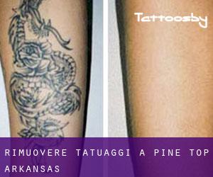 Rimuovere Tatuaggi a Pine Top (Arkansas)