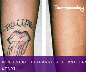 Rimuovere Tatuaggi a Pirmasens Stadt