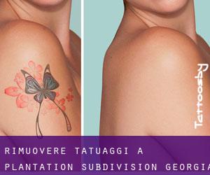 Rimuovere Tatuaggi a Plantation Subdivision (Georgia)