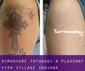 Rimuovere Tatuaggi a Pleasant View Village (Indiana)