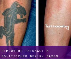 Rimuovere Tatuaggi a Politischer Bezirk Baden