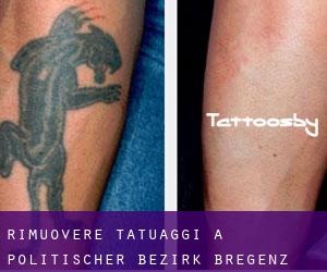 Rimuovere Tatuaggi a Politischer Bezirk Bregenz