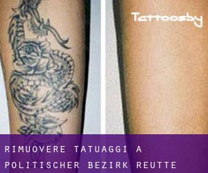 Rimuovere Tatuaggi a Politischer Bezirk Reutte