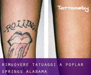 Rimuovere Tatuaggi a Poplar Springs (Alabama)