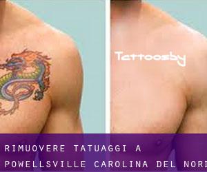 Rimuovere Tatuaggi a Powellsville (Carolina del Nord)