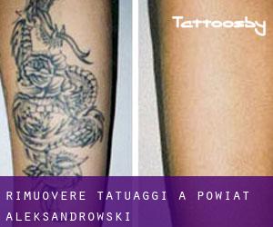 Rimuovere Tatuaggi a Powiat aleksandrowski