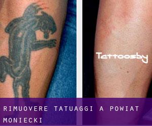 Rimuovere Tatuaggi a Powiat moniecki