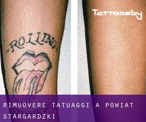 Rimuovere Tatuaggi a Powiat stargardzki