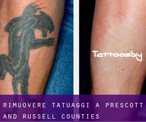 Rimuovere Tatuaggi a Prescott and Russell Counties