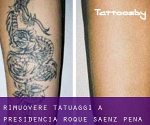 Rimuovere Tatuaggi a Presidencia Roque Sáenz Peña