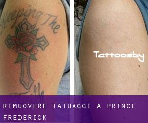 Rimuovere Tatuaggi a Prince Frederick
