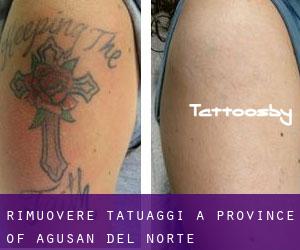 Rimuovere Tatuaggi a Province of Agusan del Norte