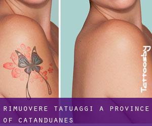 Rimuovere Tatuaggi a Province of Catanduanes