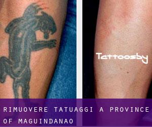 Rimuovere Tatuaggi a Province of Maguindanao