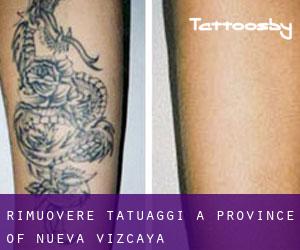Rimuovere Tatuaggi a Province of Nueva Vizcaya