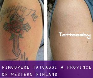 Rimuovere Tatuaggi a Province of Western Finland