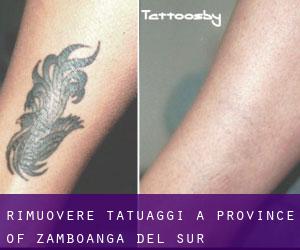 Rimuovere Tatuaggi a Province of Zamboanga del Sur