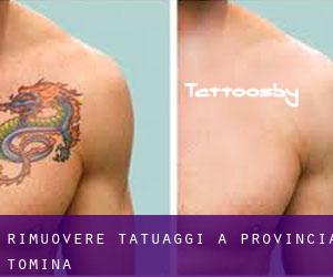 Rimuovere Tatuaggi a Provincia Tomina