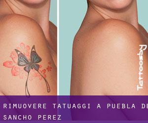 Rimuovere Tatuaggi a Puebla de Sancho Pérez