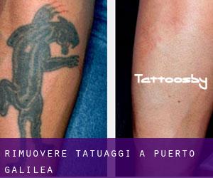 Rimuovere Tatuaggi a Puerto Galilea