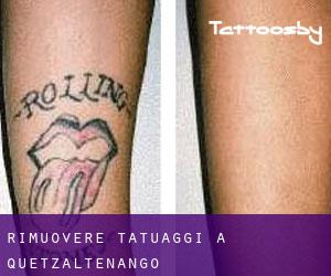 Rimuovere Tatuaggi a Quetzaltenango