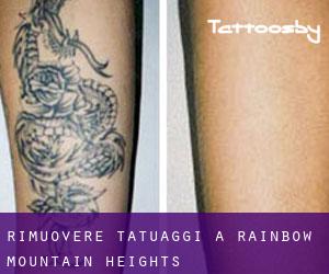 Rimuovere Tatuaggi a Rainbow Mountain Heights