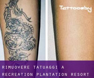 Rimuovere Tatuaggi a Recreation Plantation Resort